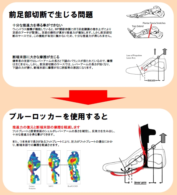 前足部切断者の利用画像