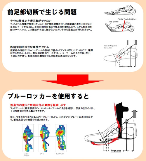 Particalfoot_2 前足部切断者の利用画像